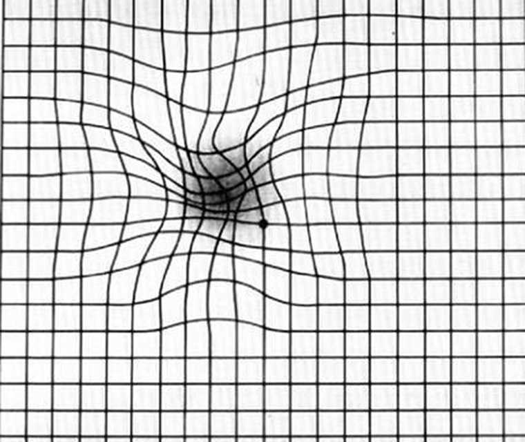 Ratgeber Makula: Das Bild zeigt ein verzerrtes Amlser-Gitter Die Grafik zeigt ein Gitter, bei dem ein schwarzer Fleck unscharf erscheint. Zudem sind einige der Linien verzerrt. Diese Darstellung illustriert damit ein mögliches Symptom des DMÖ – verzerrtes Sehen.