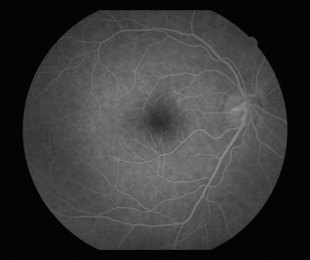 Das Bild zeigt eine Schwarz-Weiß-Aufnahme im Rahmen einer Fluoreszenz-Angiographie. Einzelne Netzhautgefäße eines gesunden Auges sind zu sehen.