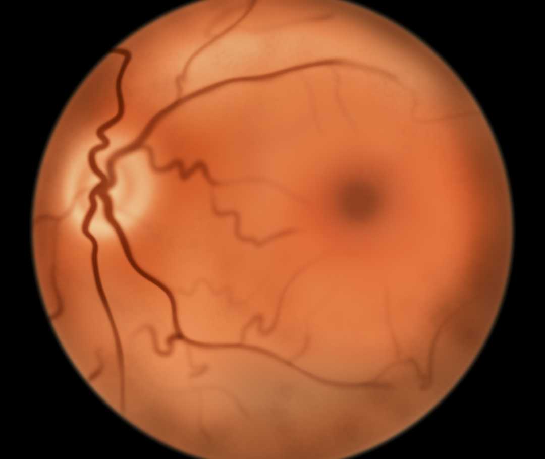 Das Bild zeigt eine Aufnahme im Rahmen einer Funduskopie, auch Ophthalmoskopie genannt. Zu sehen ist der Augenhintergrund eines gesunden Auges.