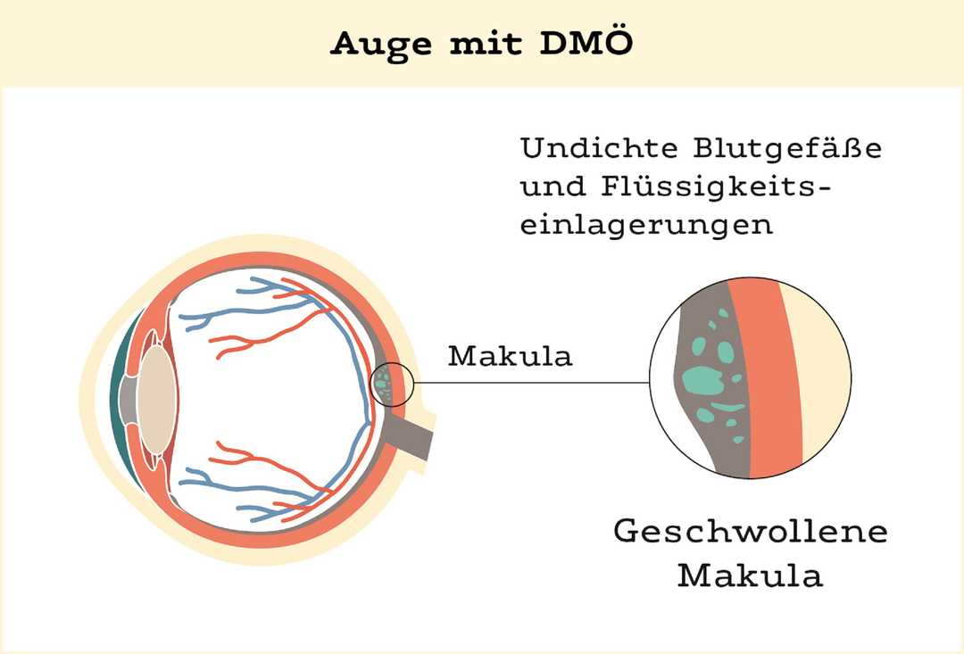 Auge mit DMÖ Auge mit DMÖ