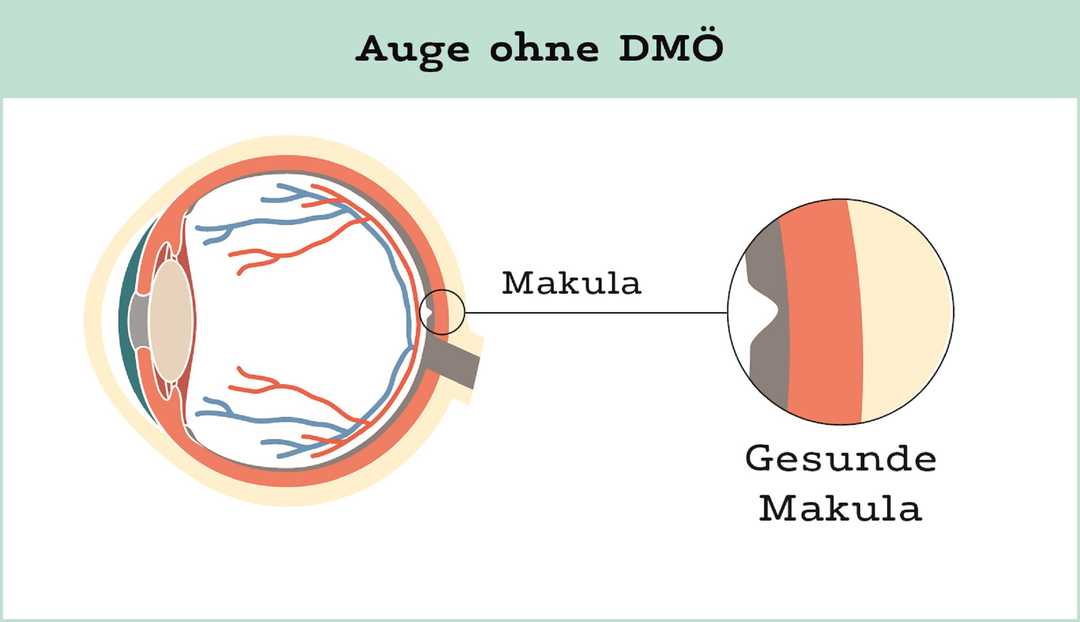 Auge ohne DMÖ Auge ohne DMÖ