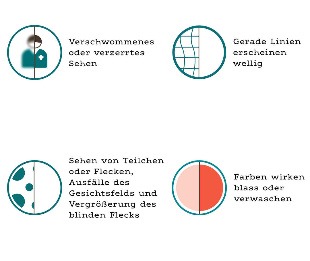 Vier Grafiken illustrieren die Symptome des DMÖ. Jede Grafik ist zweigeteilt. Der linke Teil zeigt die Sicht bei erkranktem Auge, der rechte Teil bei gesundem Auge. In der ersten Grafik ist etwa der linke Teil verschwommen und der rechte scharf zu sehen. Vier Grafiken illustrieren die Symptome des DMÖ. Jede Grafik ist zweigeteilt. Der linke Teil zeigt die Sicht bei erkranktem Auge, der rechte Teil bei gesundem Auge. In der ersten Grafik ist etwa der linke Teil verschwommen und der rechte scharf zu sehen.